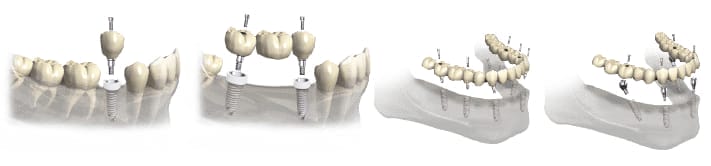 Z1 Tissue Level Implants - TBR Dental